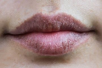 Bukan Hanya Merokok, Ternyata 7 Faktor Ini Dapat Membuat Bibir Menjadi Hitam