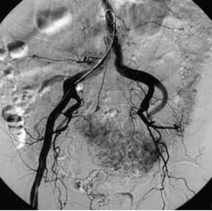 Mengenal Digital Subtraction Angiography, Pemeriksaan Pembuluh Darah untuk Deteksi Gangguan Kesehatan