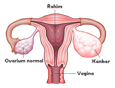 Kanker Ovarium, Satu Dari 3 Jenis Kanker yang Paling Banyak Dialami Wanita