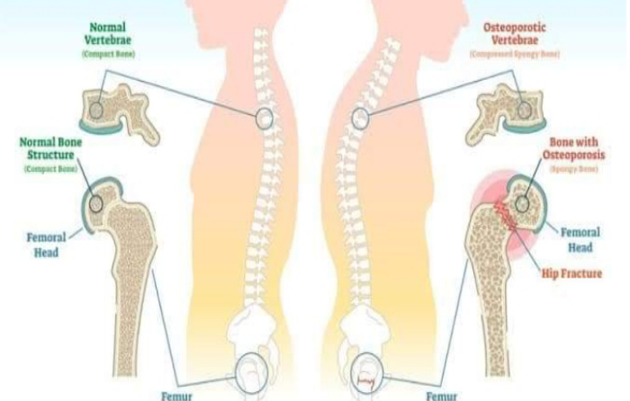 Cegah Osteoporosis Bisa Dilakukan Melalui Pola Makan, Simak Tips ini