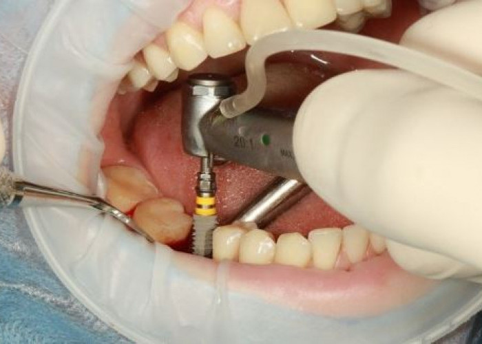 RSHS Buka Suara Terkait Dugaan Malpraktik yang Viral Karena Pasien Meninggal Sebelum Operasi Cabut Gigi