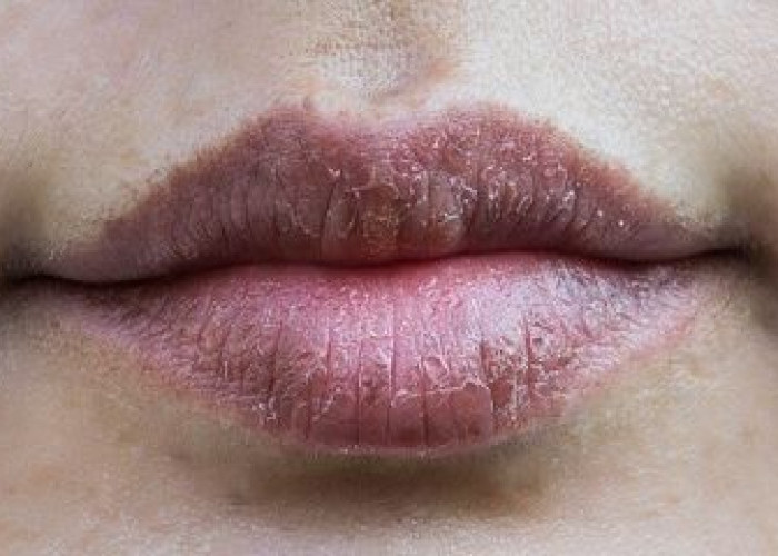 Bukan Hanya Merokok, Ternyata 7 Faktor Ini Dapat Membuat Bibir Menjadi Hitam