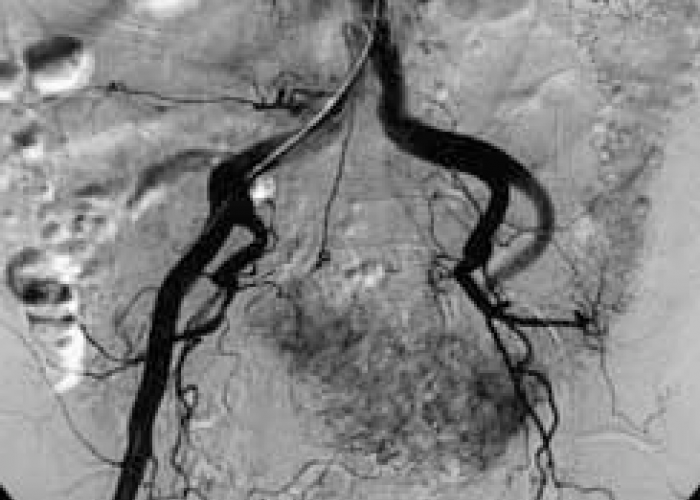 Mengenal Digital Subtraction Angiography, Pemeriksaan Pembuluh Darah untuk Deteksi Gangguan Kesehatan