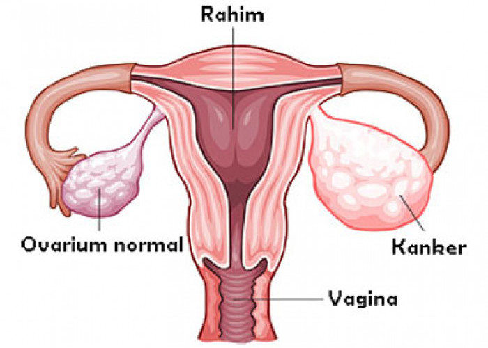 Kanker Ovarium, Satu Dari 3 Jenis Kanker yang Paling Banyak Dialami Wanita