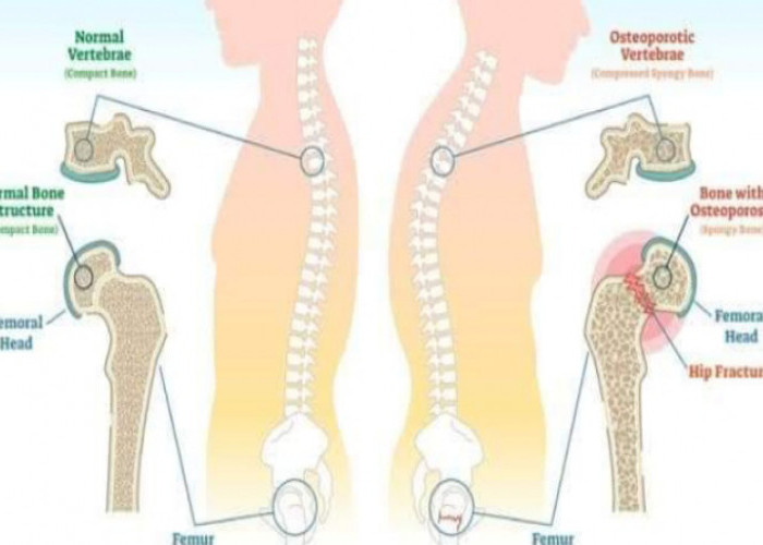 Cegah Osteoporosis Bisa Dilakukan Melalui Pola Makan, Simak Tips ini