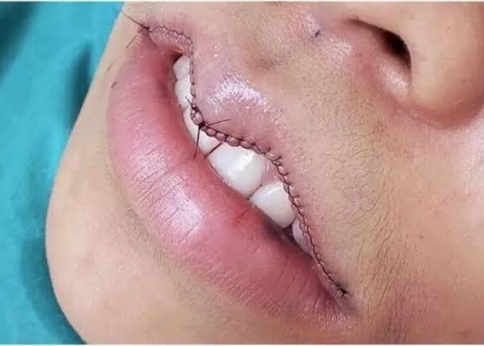 Bukan Cuma Operasi, Berikut Cara Mengecilkan Ukuran Bibir Dengan Bantuan Medis.