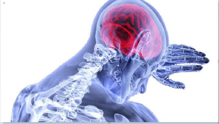 Waspada Pendarahan Otak, Kenali Gejala dan Penyebabnya