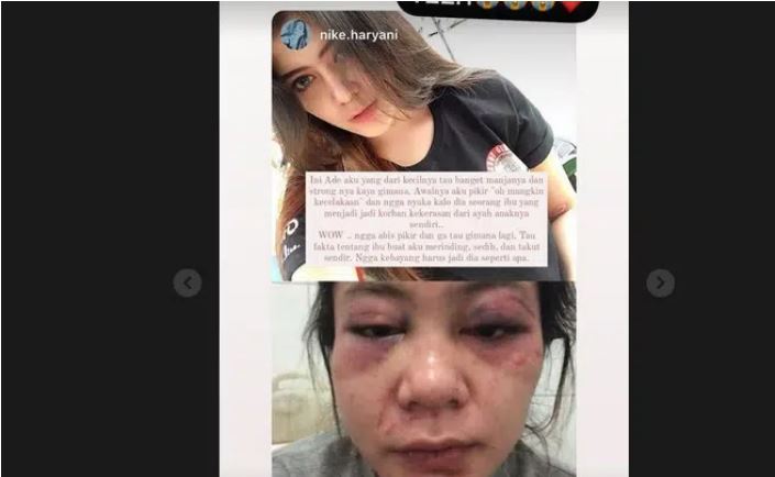 Jadi Korban KDRT oleh Suami, Wajah Shalsabilla Putri Babak Belur dan Gegar Otak