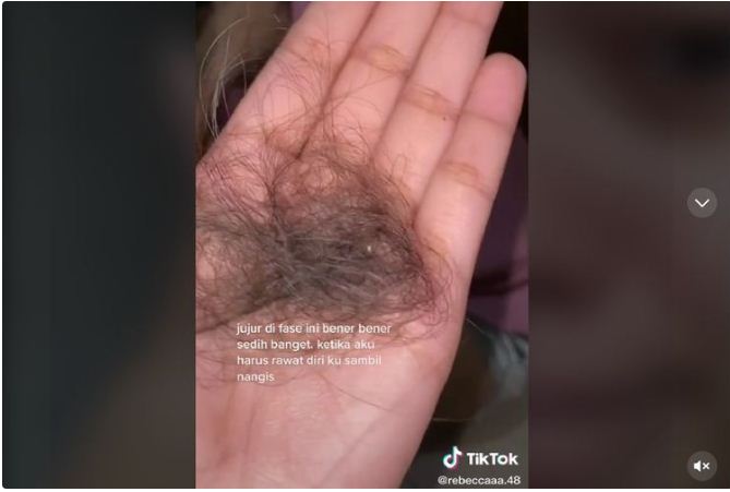 Viral, Positif Omicron Buat Rambut Wanita ini Rontok